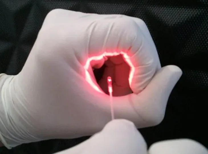 Cirugia de fístula anal com laser de diodo