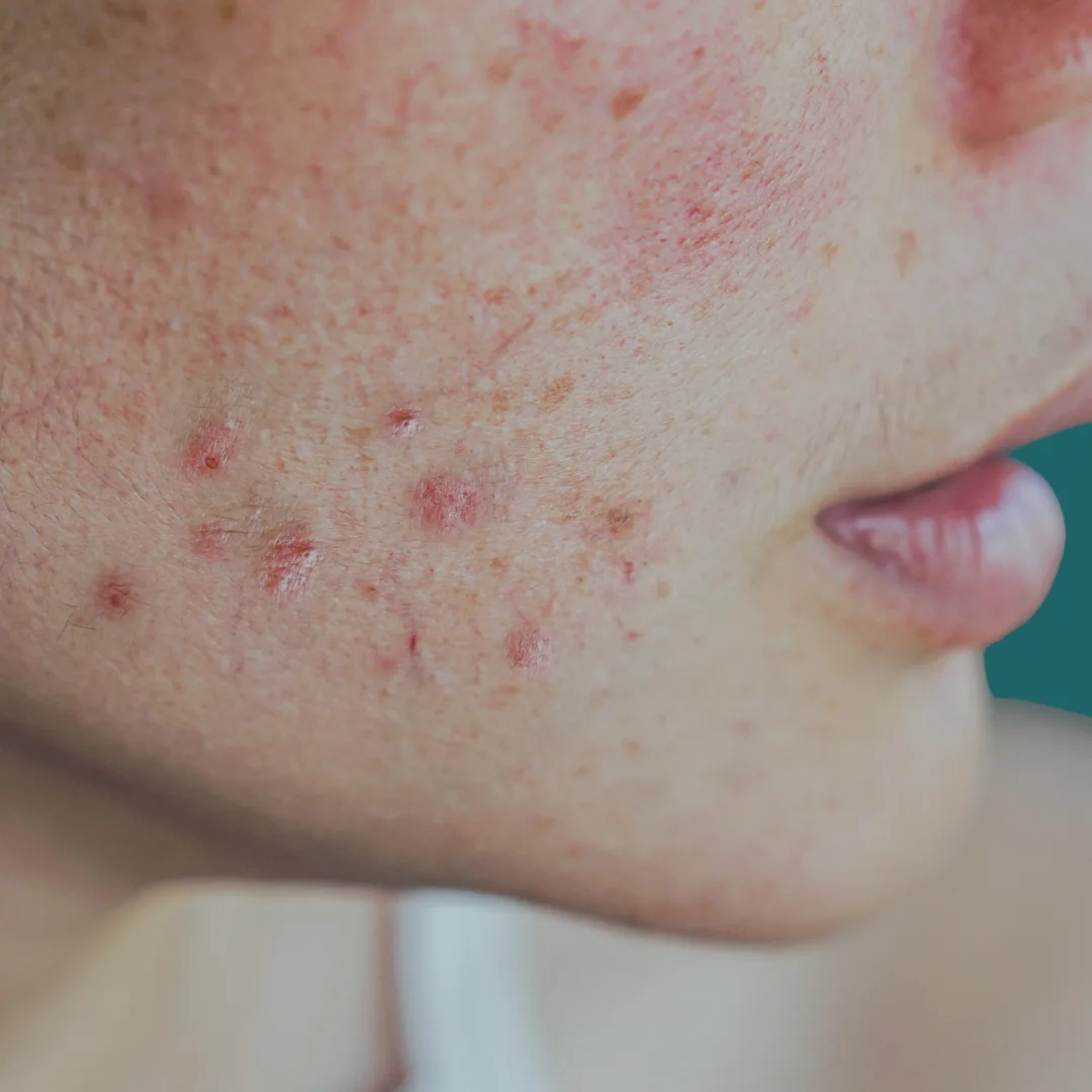 Dermatologia na Liorci Clinic