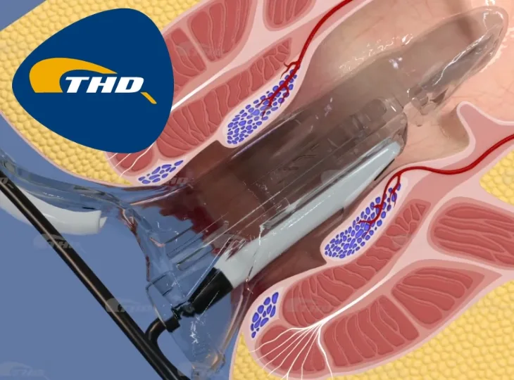 Cirurgia de Hemorroidas técnica THD- Desarterialização