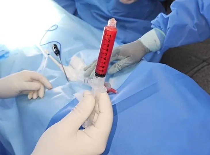 Uso de células tronco para fístula anal - Sefficare