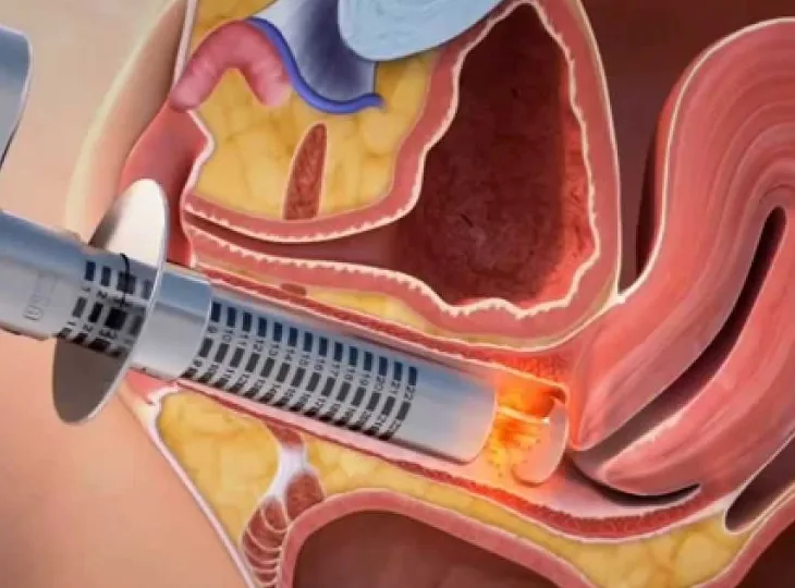 Marisca/Plicoma anal em consultório com laser de co2